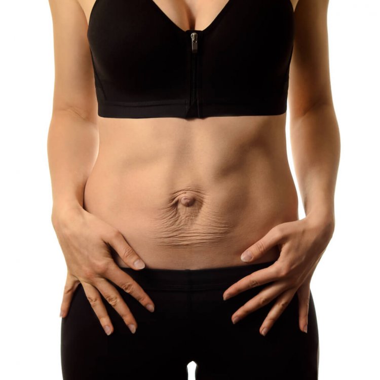 Diastasis recti. Woman's abdomen divergence of the muscles of the abdomen after pregnancy and childbirth.